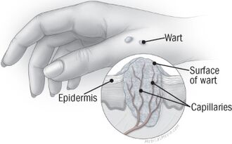 La struttura della verruca sulla mano