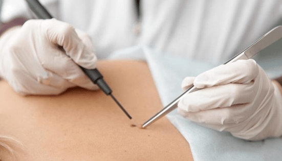 Caratteristiche della rimozione del papilloma