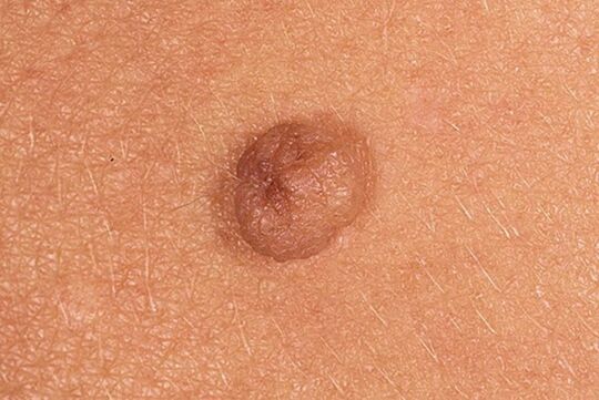 Papilloma semplice