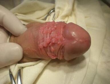 Papilloma su un membro