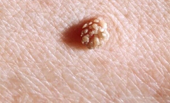 Papilloma sul corpo umano