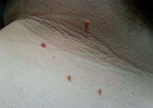 Papillomi sul collo