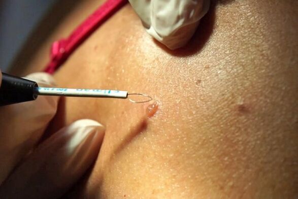 Rimozione delle verruche sul corpo
